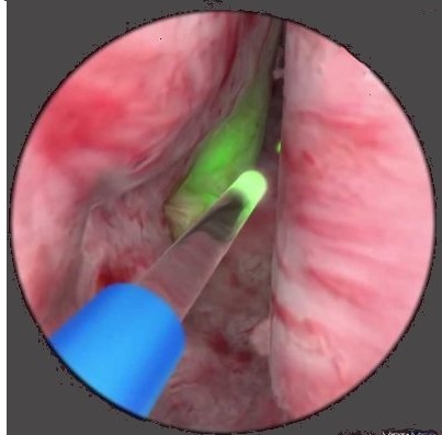 LASER PROSTATE SURGERY(HOLEP) ICON